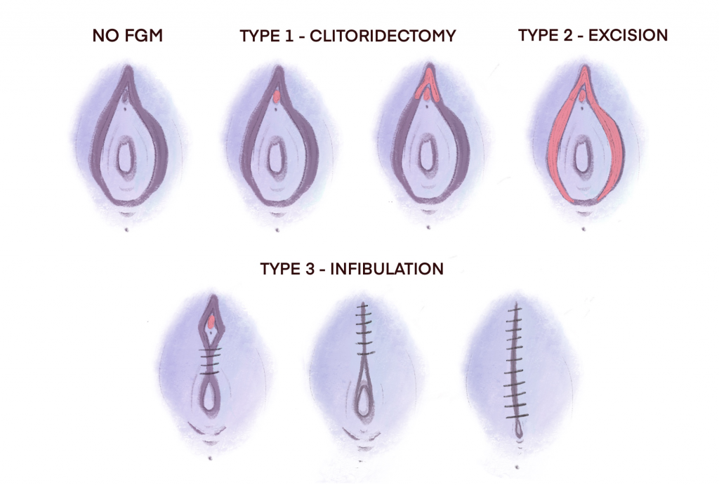 Types of FGM
